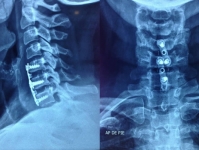 Paciente femenino de 53 años con dos hernias de disco cervicales, se instrumentó con caja-placa en dos niveles con excelente resultado y pronta recuperación.